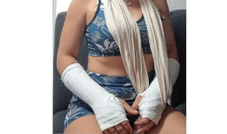 Un perro quiso morderla, cayó de la bicicleta y sufrió fracturas en ambas muñecas